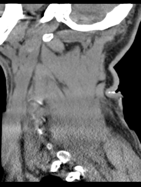 File:Cavernoma of cervical cord (Radiopaedia 50838-56346 B 66).png