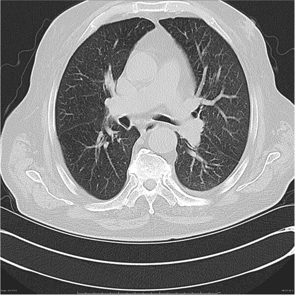 File:Cavitating left lower lobe lesion - squamous cell lung cancer (Radiopaedia 27749-28176 Axial lung window 23).jpg