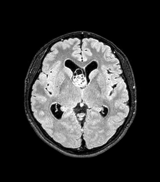 File:Central neurocytoma (Radiopaedia 79320-92380 Axial FLAIR 166).jpg