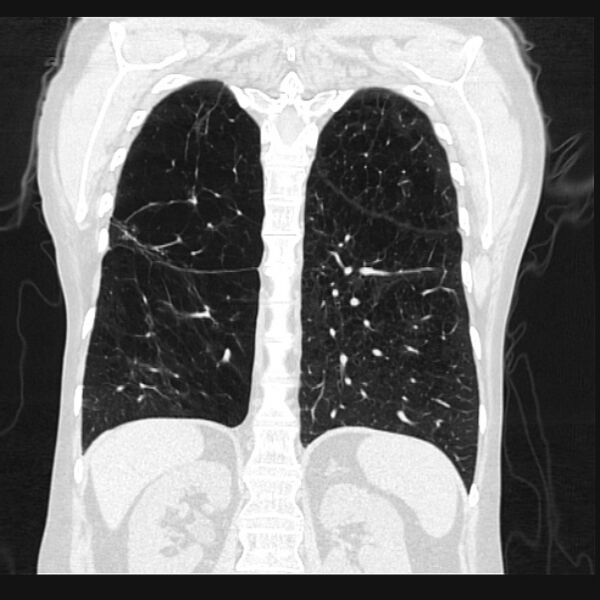 File:Centrilobular pulmonary emphysema (Radiopaedia 24495-24789 Coronal lung window 54).jpg