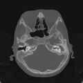 Cerebellar abscess secondary to mastoiditis (Radiopaedia 26284-26413 Axial bone window 50).jpg