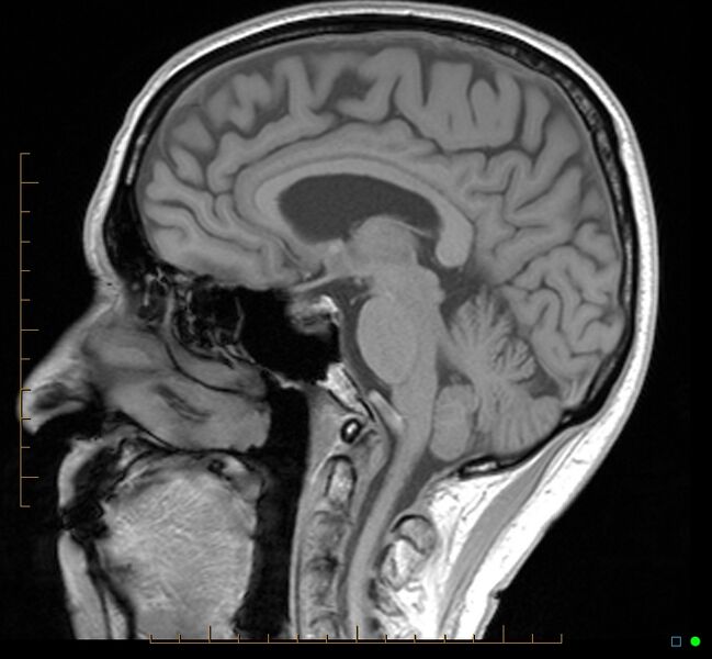 File:Cerebellar gangliocytoma (Radiopaedia 65377-74422 Sagittal T1 20).jpg