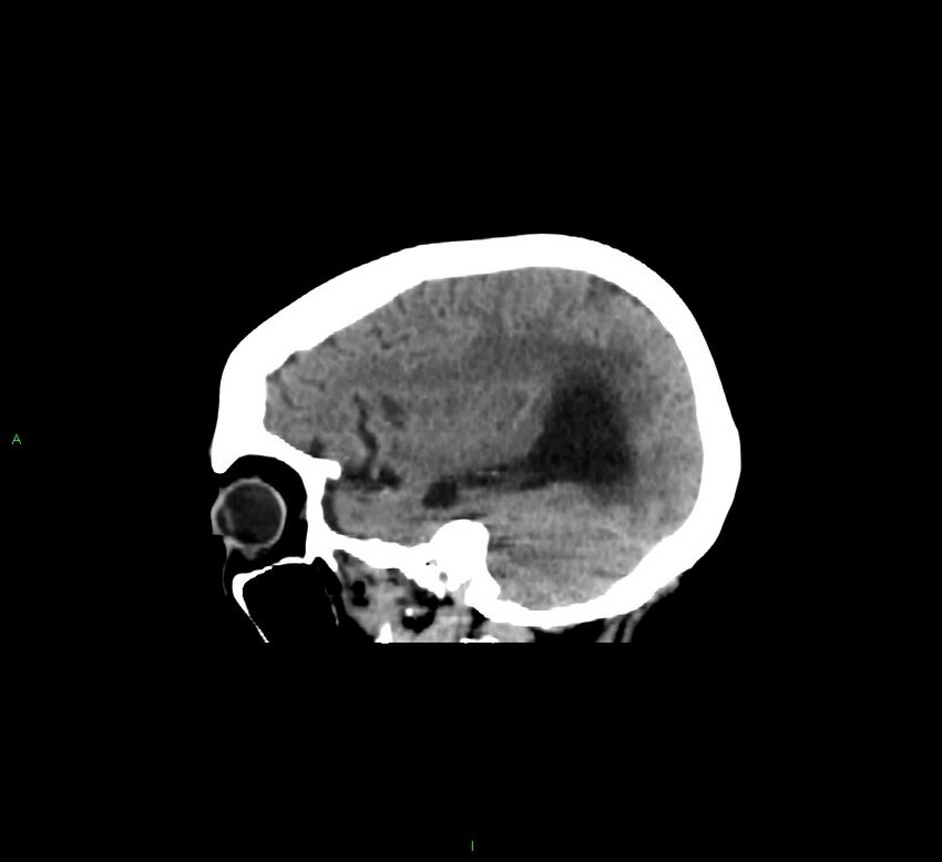 Cerebellar hemorrhage (Radiopaedia 58793-66027 C 38).jpg