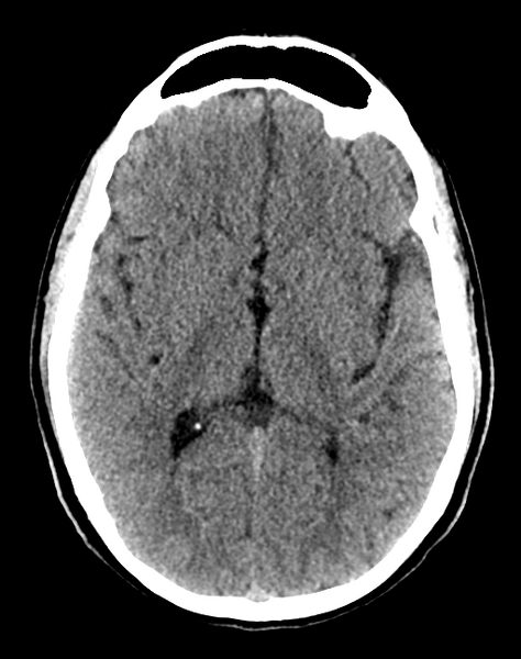 File:Cerebellar infarct due to vertebral artery dissection with posterior fossa decompression (Radiopaedia 82779-97033 Axial non-contrast 19).png