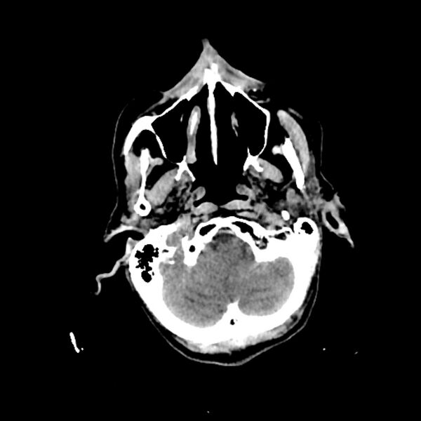File:Cerebellar metastasis - lung tumor (Radiopaedia 69317-79145 Axial non-contrast 3).jpg