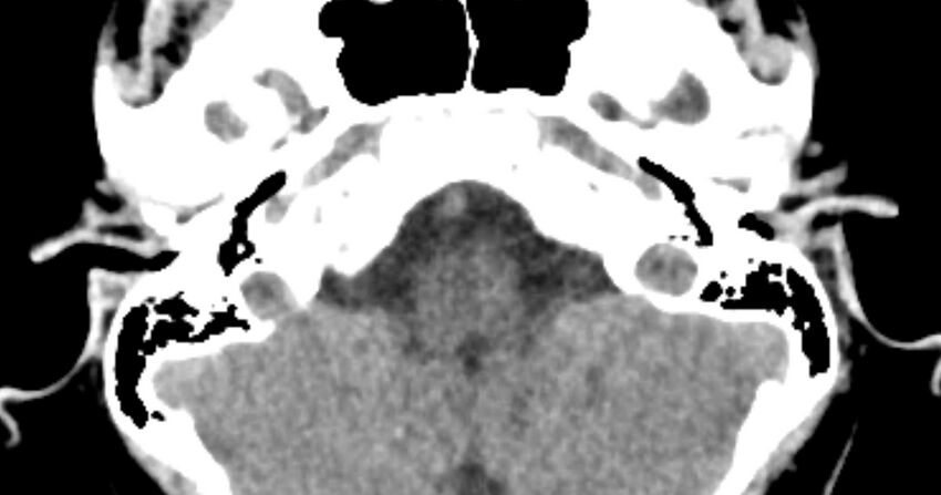 Cerebellopontine angle lipoma (Radiopaedia 57303-64242 B 21).jpg