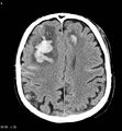 Cerebral abscesses secondary to contusions (Radiopaedia 5201-22213 Axial non-contrast 2).jpg