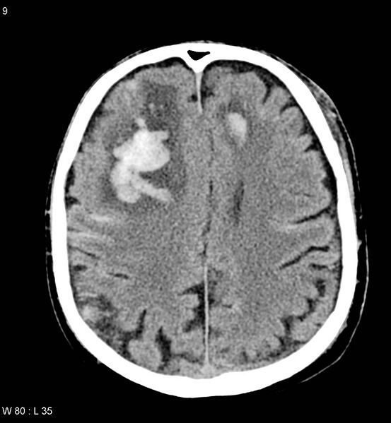 File:Cerebral abscesses secondary to contusions (Radiopaedia 5201-22213 Axial non-contrast 2).jpg