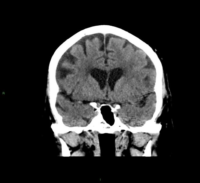 File:Cerebral amyloid angiopathy-associated lobar intracerebral hemorrhage (Radiopaedia 58376-65511 Coronal non-contrast 41).jpg