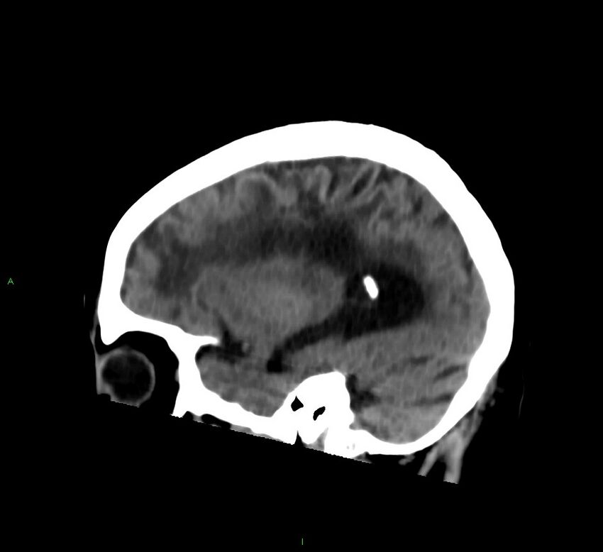 Cerebral amyloid angiopathy-associated lobar intracerebral hemorrhage (Radiopaedia 58376-65513 C 49).jpg