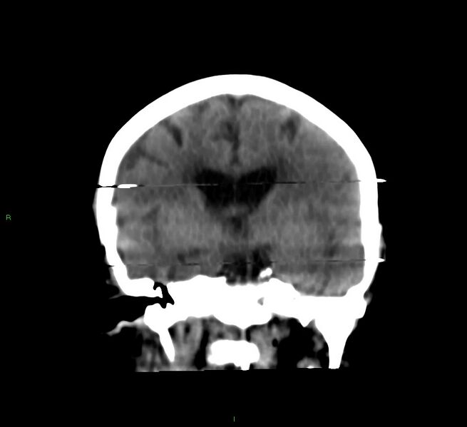File:Cerebral amyloid angiopathy-associated lobar intracerebral hemorrhage (Radiopaedia 58377-65514 Coronal non-contrast 36).jpg