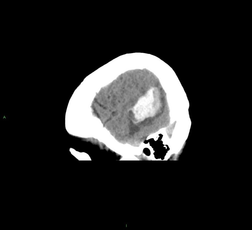 Cerebral amyloid angiopathy-associated lobar intracerebral hemorrhage (Radiopaedia 58378-65516 C 8).jpg