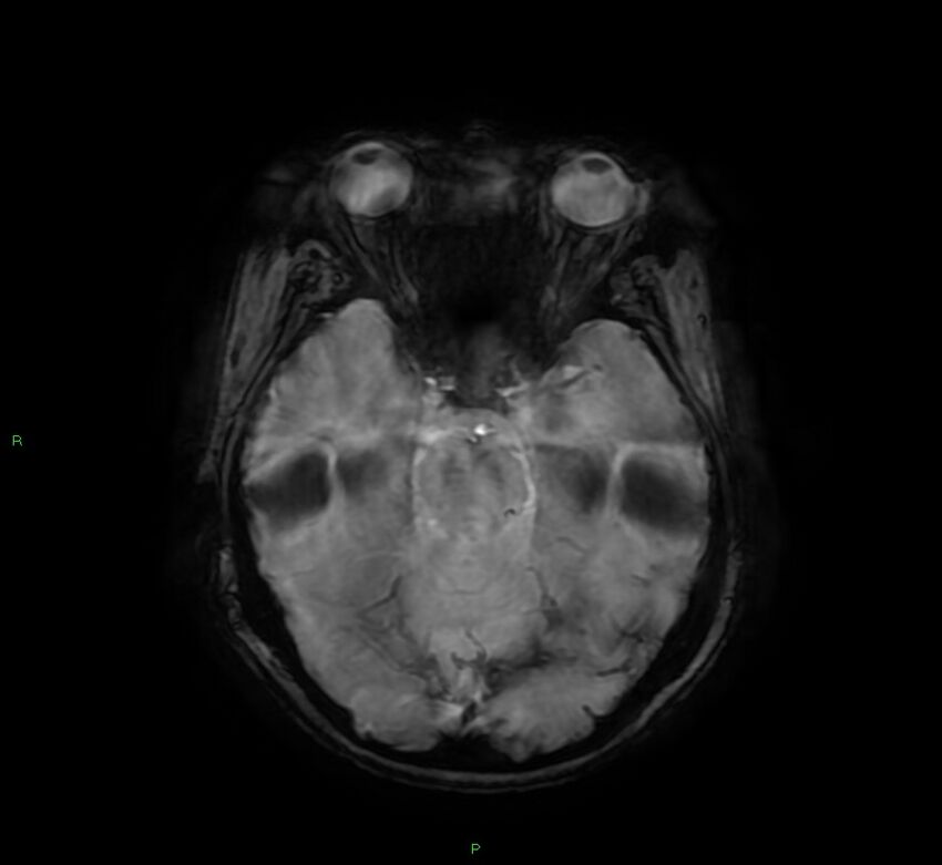 Cerebral amyloid angiopathy-associated lobar intracerebral hemorrhage (Radiopaedia 58378-65517 Axial SWI 25).jpg