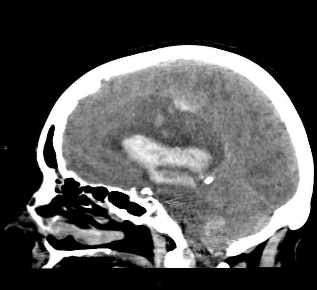 File:Cerebral amyloid angiopathy-associated lobar intracerebral hemorrhage (Radiopaedia 58379-65519 C 30).jpg