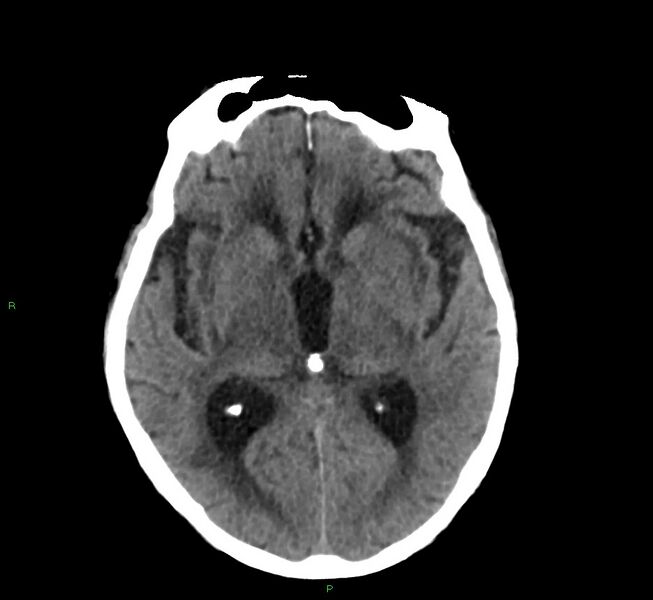 File:Cerebral amyloid angiopathy-associated lobar intracerebral hemorrhage (Radiopaedia 58530-65688 Axial non-contrast 27).jpg