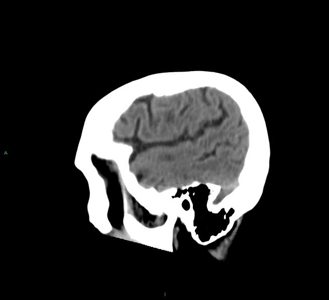 File:Cerebral amyloid angiopathy-associated lobar intracerebral hemorrhage (Radiopaedia 58530-65688 C 10).jpg