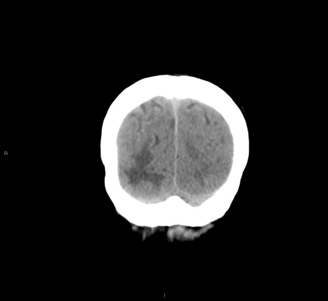 File:Cerebral amyloid angiopathy-associated lobar intracerebral hemorrhage (Radiopaedia 58561-65724 Coronal non-contrast 11).jpg