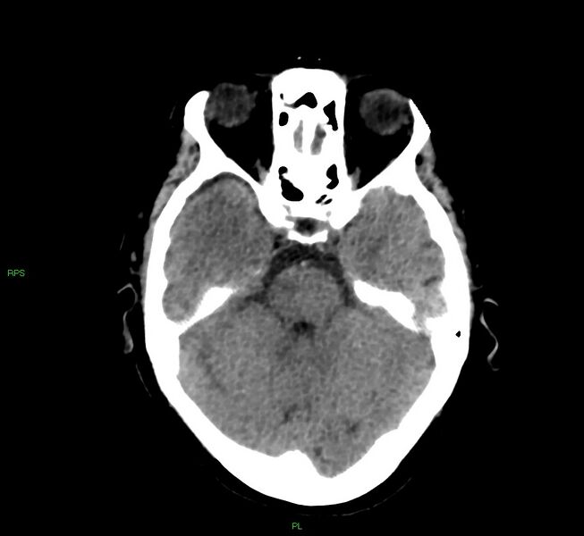 File:Cerebral amyloid angiopathy-associated lobar intracerebral hemorrhage (Radiopaedia 58569-65734 Axial non-contrast 42).jpg