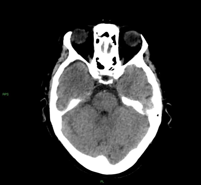 Cerebral amyloid angiopathy-associated lobar intracerebral hemorrhage (Radiopaedia 58569-65734 Axial non-contrast 42).jpg