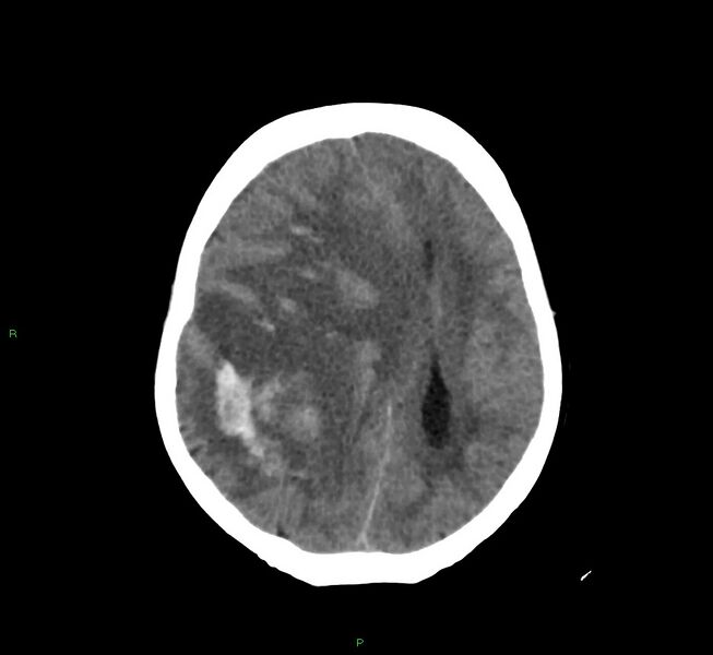 File:Cerebral amyloid angiopathy-associated lobar intracerebral hemorrhage (Radiopaedia 58751-65972 Axial non-contrast 21).jpg