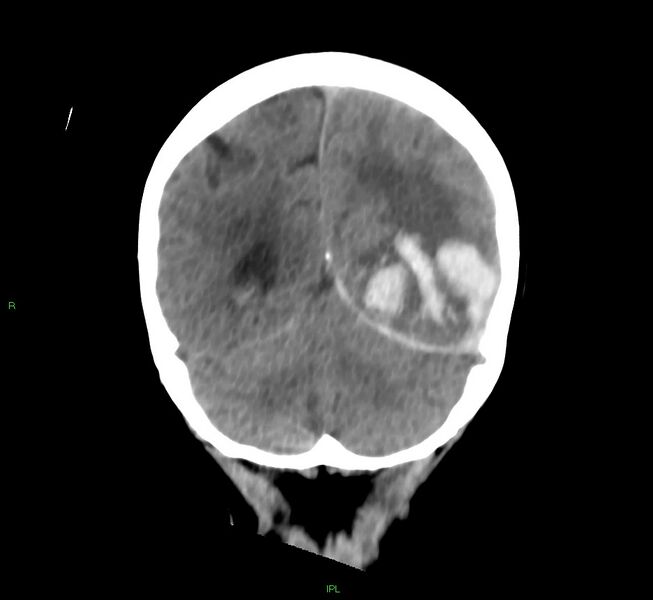 File:Cerebral amyloid angiopathy-associated lobar intracerebral hemorrhage (Radiopaedia 58754-65975 Coronal non-contrast 20).jpg