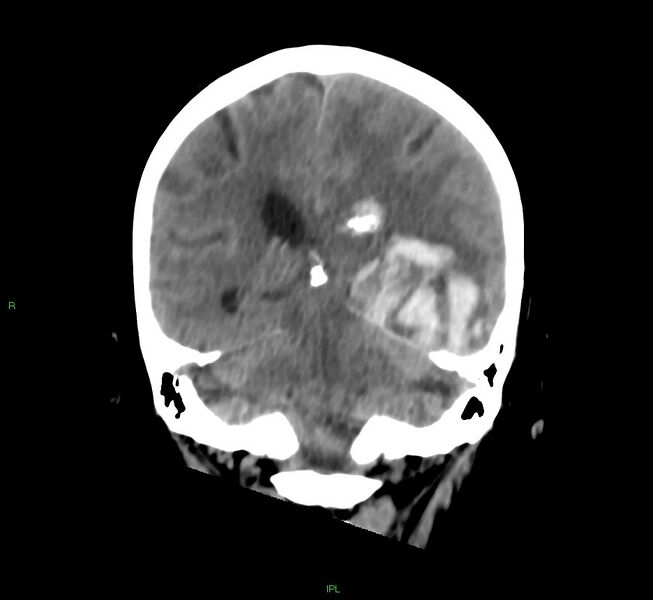 File:Cerebral amyloid angiopathy-associated lobar intracerebral hemorrhage (Radiopaedia 58754-65975 Coronal non-contrast 26).jpg