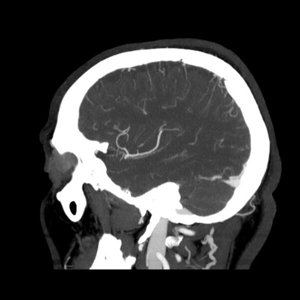 File:Cerebral arteriovenous malformation (Radiopaedia 43729-47189 D 11).jpg