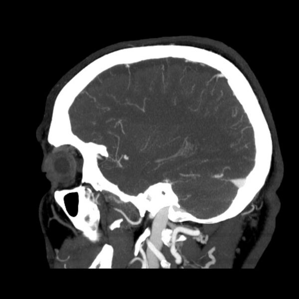 File:Cerebral arteriovenous malformation (Radiopaedia 43729-47189 D 13).jpg