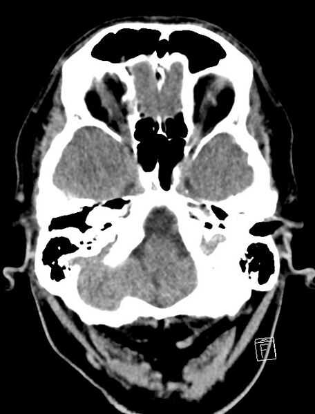 File:Cerebral arteriovenous malformation (Radiopaedia 78188-90745 Axial non-contrast 4).jpg