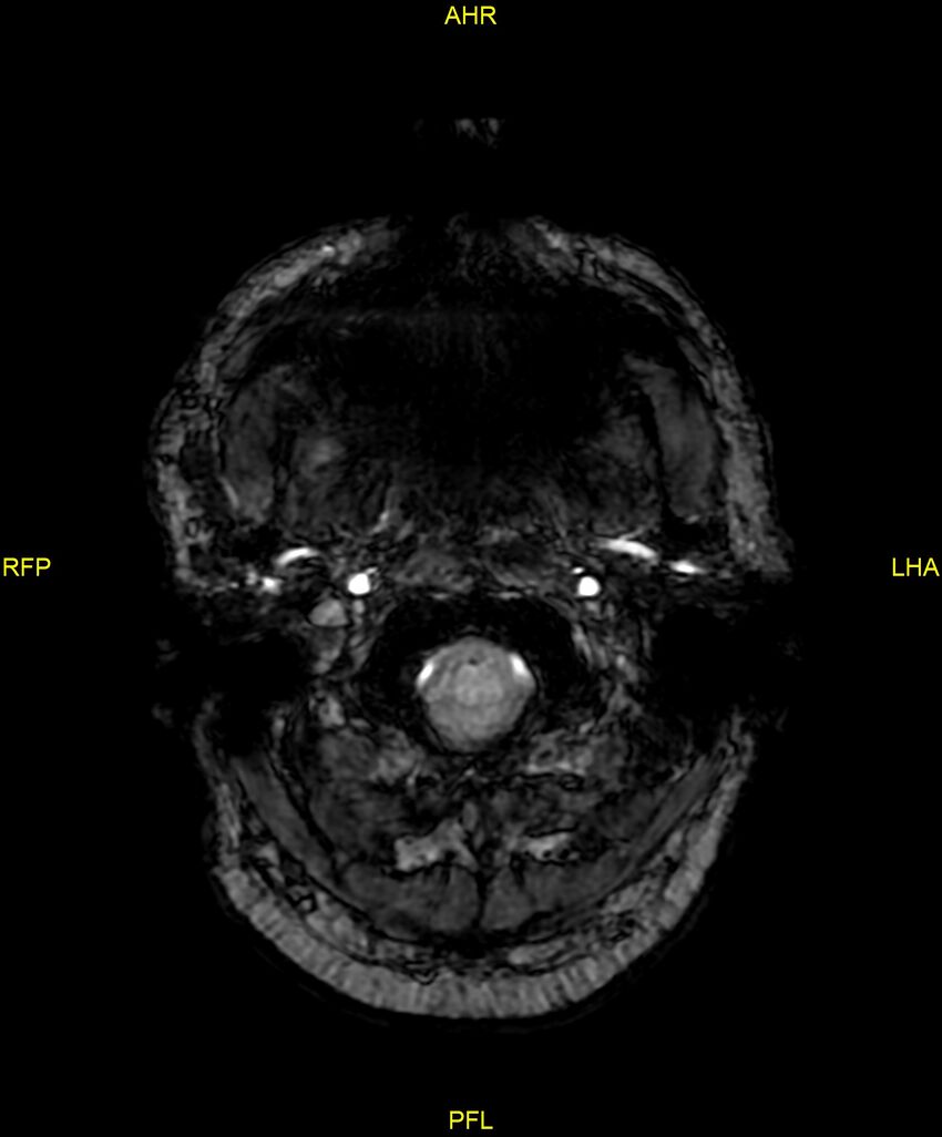 Cerebral autosomal dominant arteriopathy with subcortical infarcts and leukoencephalopathy (CADASIL) (Radiopaedia 86108-102054 Axial SWI 8).jpg