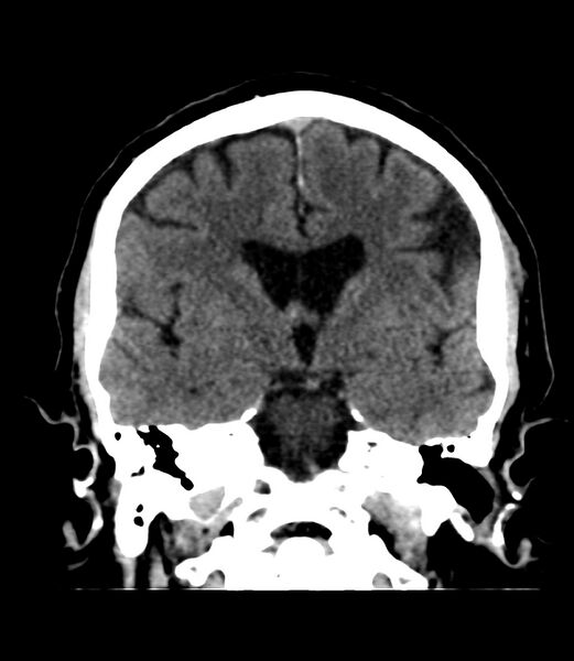File:Cerebral dural venous sinus thrombosis (Radiopaedia 86514-102575 Coronal non-contrast 23).jpg