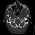 Cerebral hemorrhagic contusions (Radiopaedia 23145-23188 Axial bone window 6).jpg