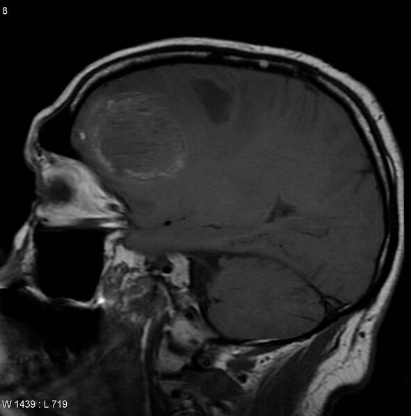 File:Cerebral metastases - renal cell carcinoma (Radiopaedia 5510-7246 Sagittal T1 3).jpg
