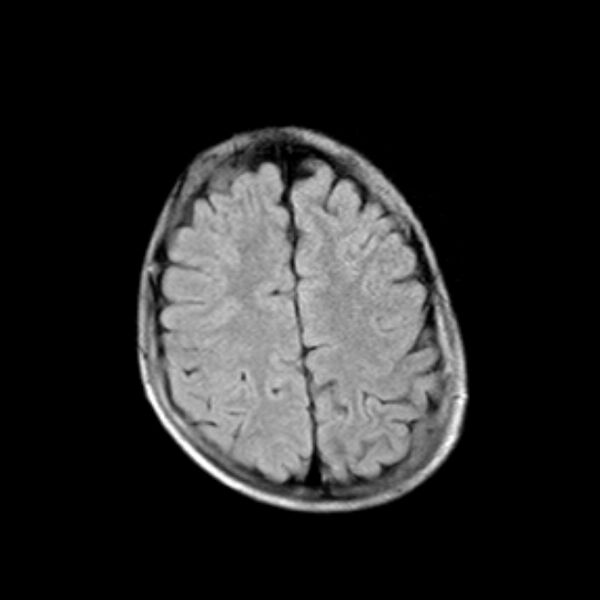 File:Cerebral tuberculoma (Radiopaedia 41152-43932 Axial FLAIR 18).jpg