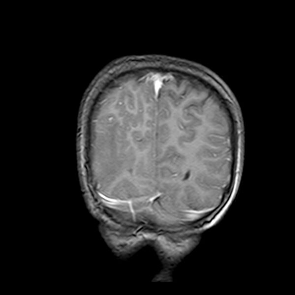 File:Cerebral tuberculoma (Radiopaedia 41152-43932 Coronal T1 C+ 19).jpg