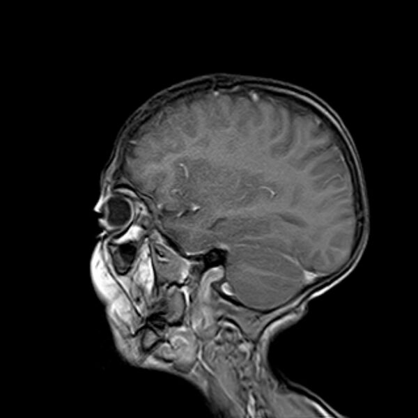 File:Cerebral tuberculoma (Radiopaedia 41152-43932 Sagittal T1 C+ 5).jpg