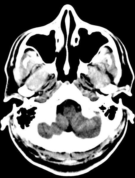 File:Cerebral venous angioma (Radiopaedia 69959-79977 Axial non-contrast 6).jpg