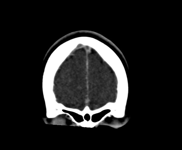File:Cerebral venous sinus thrombosis (Radiopaedia 59224-66646 Coronal C+ delayed 5).jpg