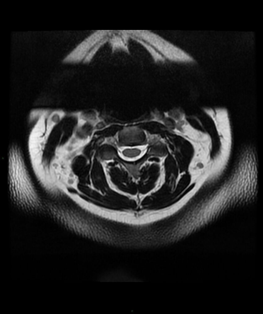 Cervical disc prolapse (Radiopaedia 80258-93598 Axial T2 6).jpg
