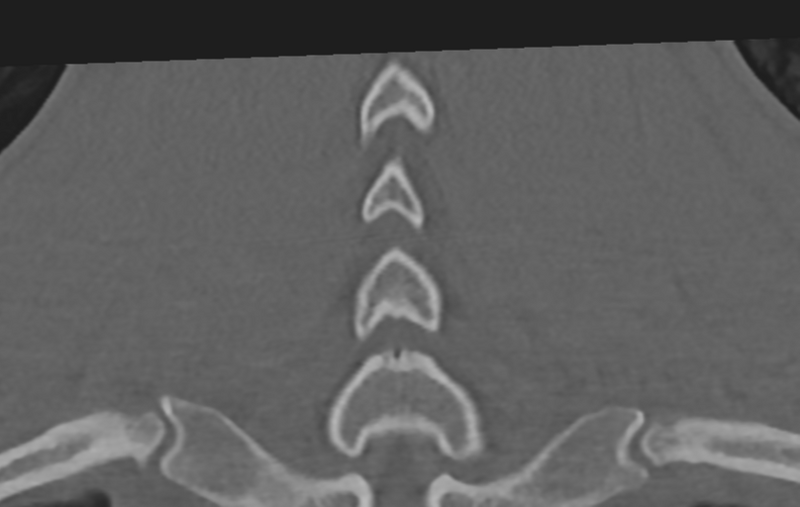 File:Cervical disc replacement (Radiopaedia 37383-39205 Coronal bone window 50).png