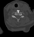 Cervical spine ACDF loosening (Radiopaedia 48998-54070 Axial bone window 40).png