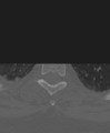 Cervical spine ACDF loosening (Radiopaedia 48998-54071 Axial bone window 63).png