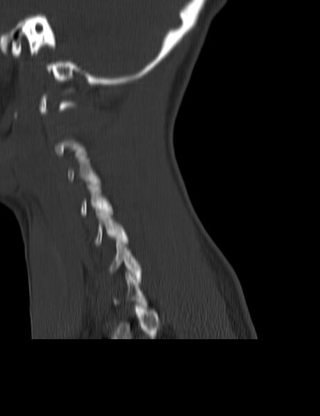 File:Cervical spine posterior ligamentous complex rupture (Radiopaedia 63486-72101 Sagittal bone window 2).jpg