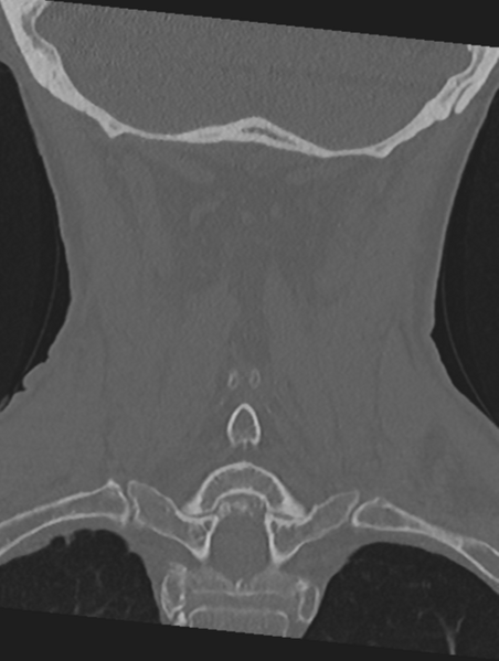 File:Cervical spondylolysis (Radiopaedia 49616-54811 Coronal bone window 43).png
