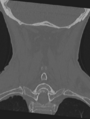 Cervical spondylolysis (Radiopaedia 49616-54811 Coronal bone window 43).png