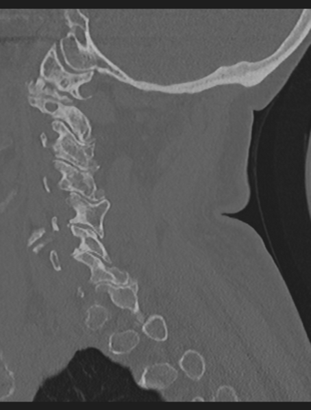 File:Cervical spondylolysis (Radiopaedia 49616-54811 Sagittal bone window 25).png