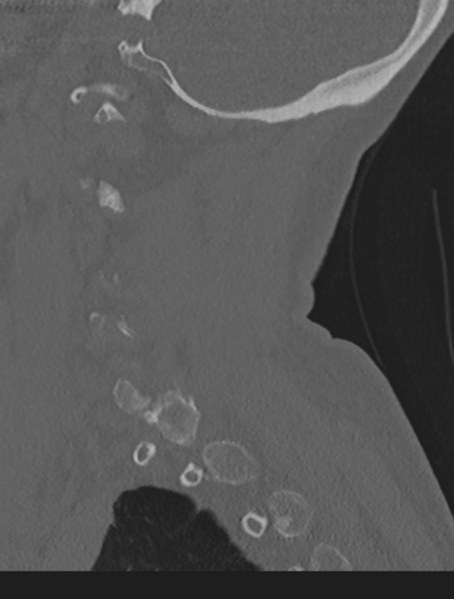 File:Cervical spondylolysis (Radiopaedia 49616-54811 Sagittal bone window 55).png