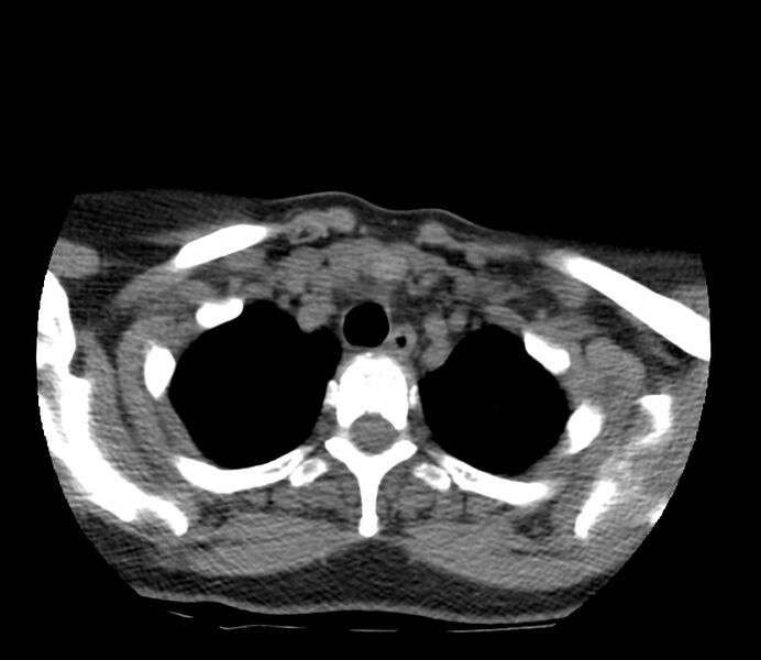 File:Cervical venous malformation (Radiopaedia 22653-22672 Axial non-contrast 51).jpg