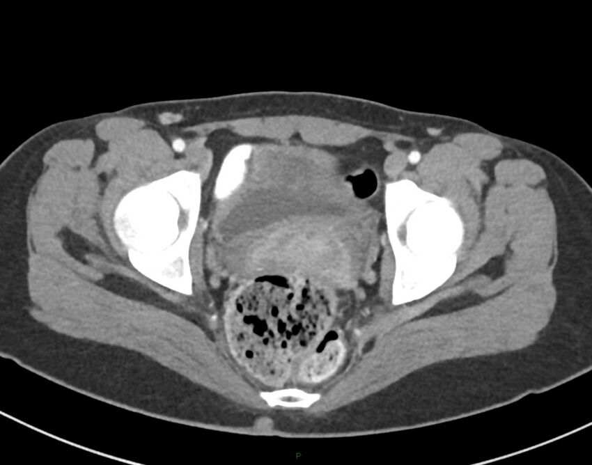 Cesarean scar endometriosis (Radiopaedia 82925-97262 A 80).jpg