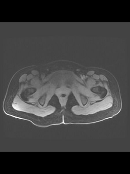 File:Cesarean section scar endometrioma (Radiopaedia 56569-63297 Axial T1 C+ fat sat 1).jpg